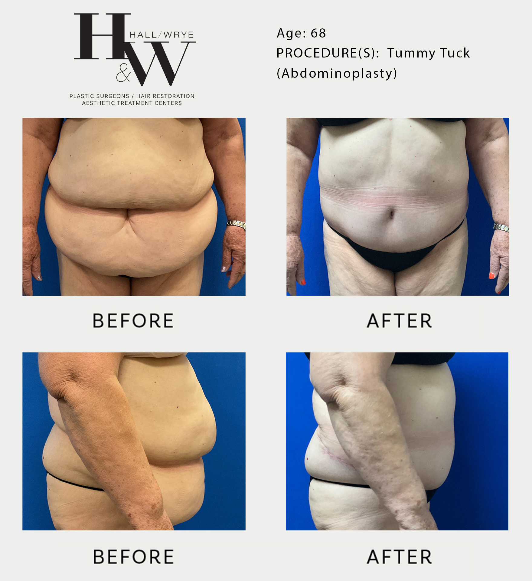 A Realistic Perspective on the Nuances of Tummy Tuck Surgery
