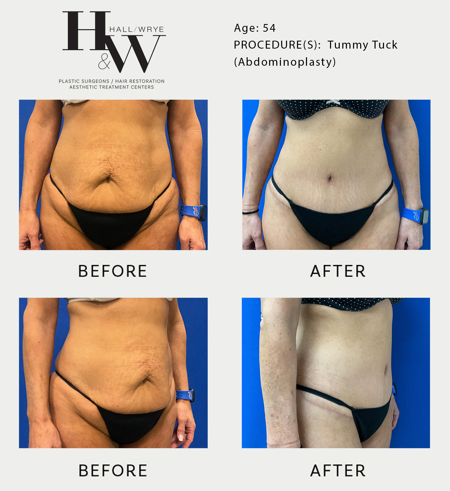 TUMMY TUCK (ABDOMINOPLASTY) - Hall & Wrye – Plastic Surgery and Medical Spa  in Reno NV, Breast Implants and Breast Augmentation, Liposuction, Tummy- Tucks, Dermal Fillers, Hair Transplants and more! Licensed Reno Plastic
