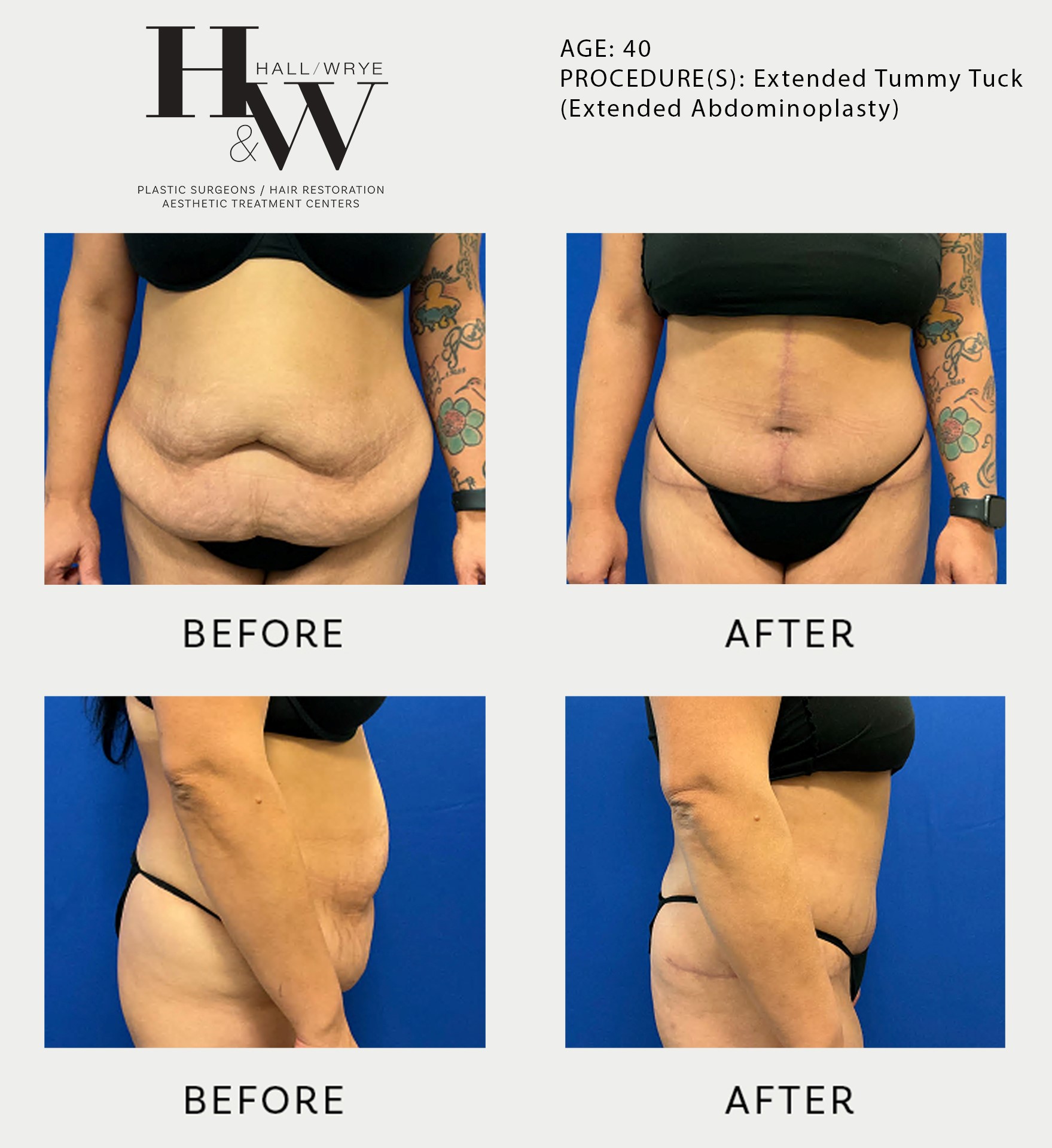 Tummy Tuck (Abdominoplasty), Woman - Age 40 - Before & After Photos