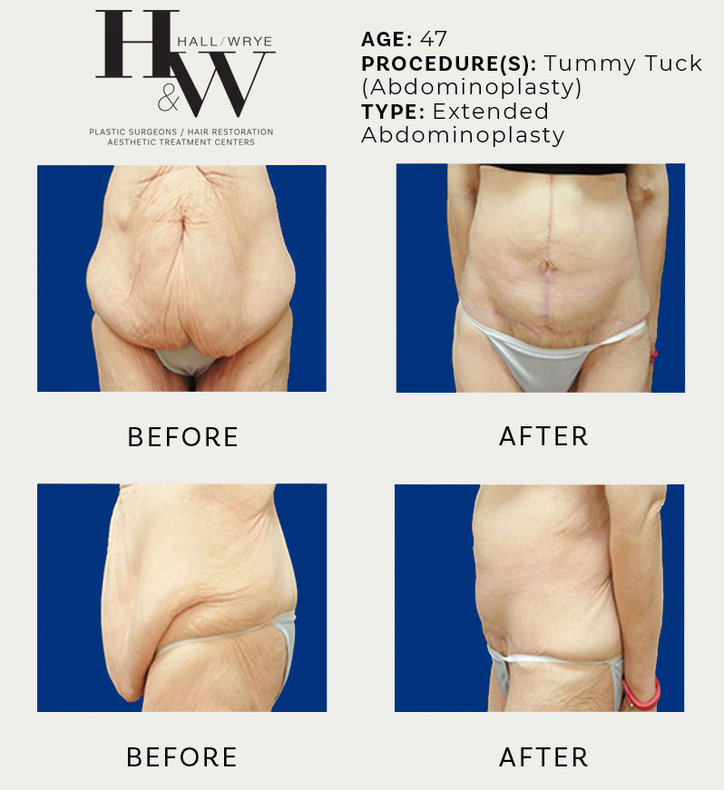 TUMMY TUCK (ABDOMINOPLASTY) - Hall & Wrye – Plastic Surgery and