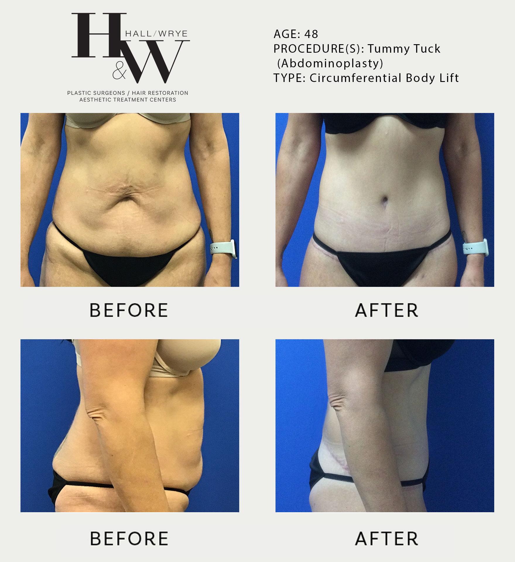 Patient #5745 Tummy Tuck (Abdominoplasty) Small Size Before and