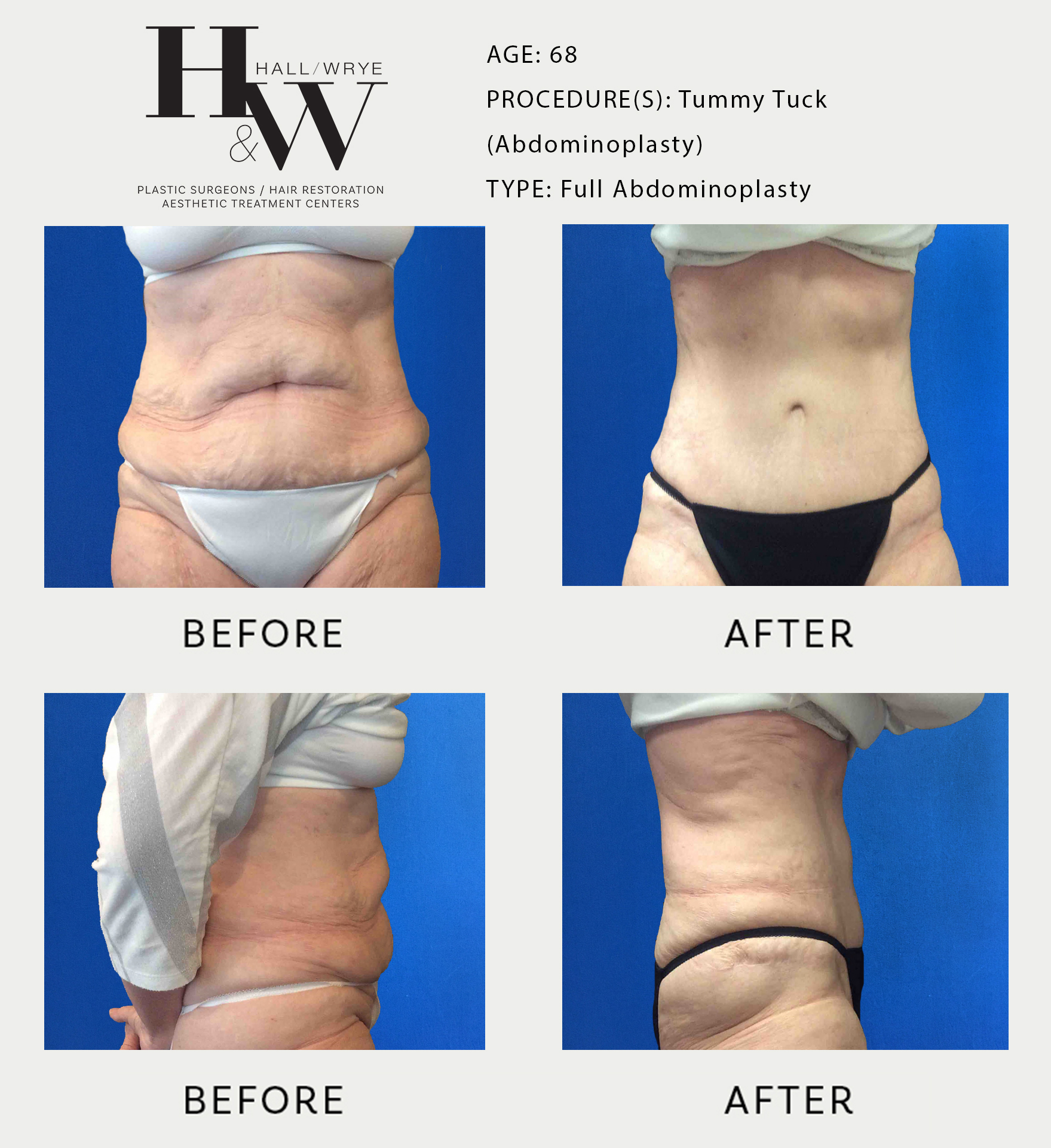 Abdominoplasty / Tummy Tuck - Modern Plastic Surgery Miami