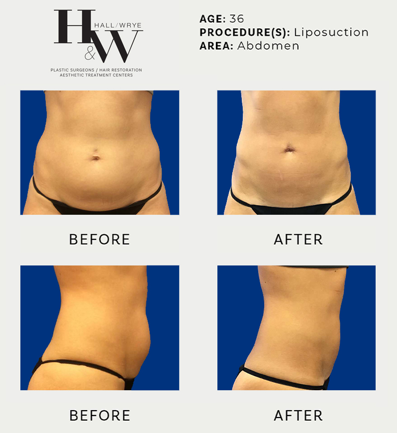 Liposuction Fort Worth