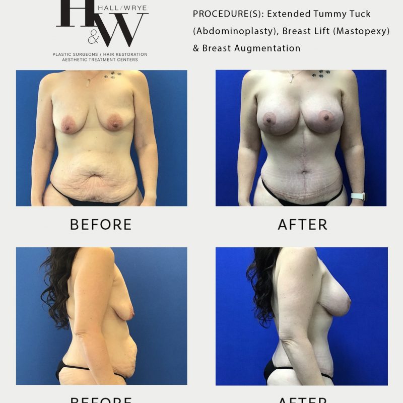 Natural Or Athletic Breast Augmentation - Hall & Wrye – Plastic